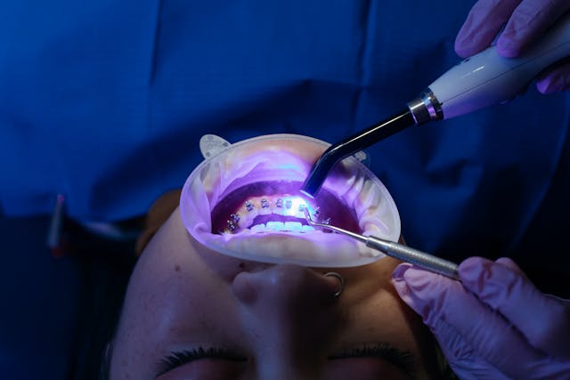 Lee más sobre el artículo Blanqueamiento dental: Mitos y verdades sobre cómo lograr una sonrisa brillante
