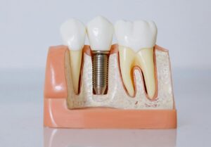 Lee más sobre el artículo Limpieza profesional de implantes dentales: La clave para mantener tu sonrisa saludable y duradera