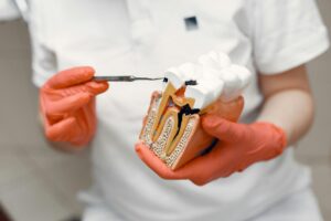 Lee más sobre el artículo Caries silenciosas: cuando no duelen… pero sí dañan