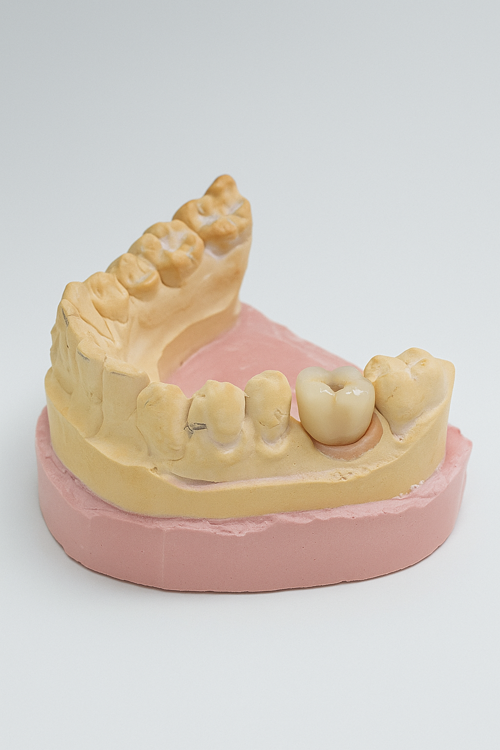 En este momento estás viendo Coronas sobre implantes: la solución definitiva para recuperar tu sonrisa