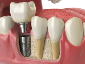 Lee más sobre el artículo 🦷 Cómo saber si necesitas un implante dental (y no una corona o un puente)